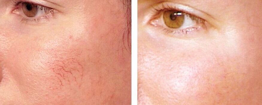 rosacea ၏ဖယ်ရှားရေး
